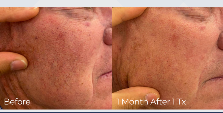 Rosacea and broken capillaries treatment