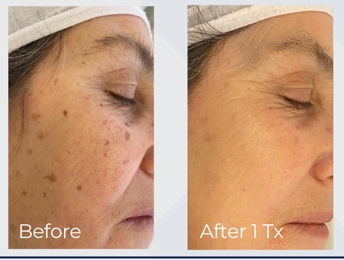 IPL pigmentation treatment