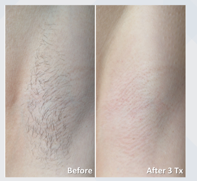 Laser hair removal